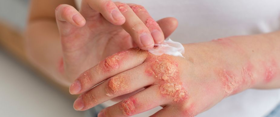 fungal infection