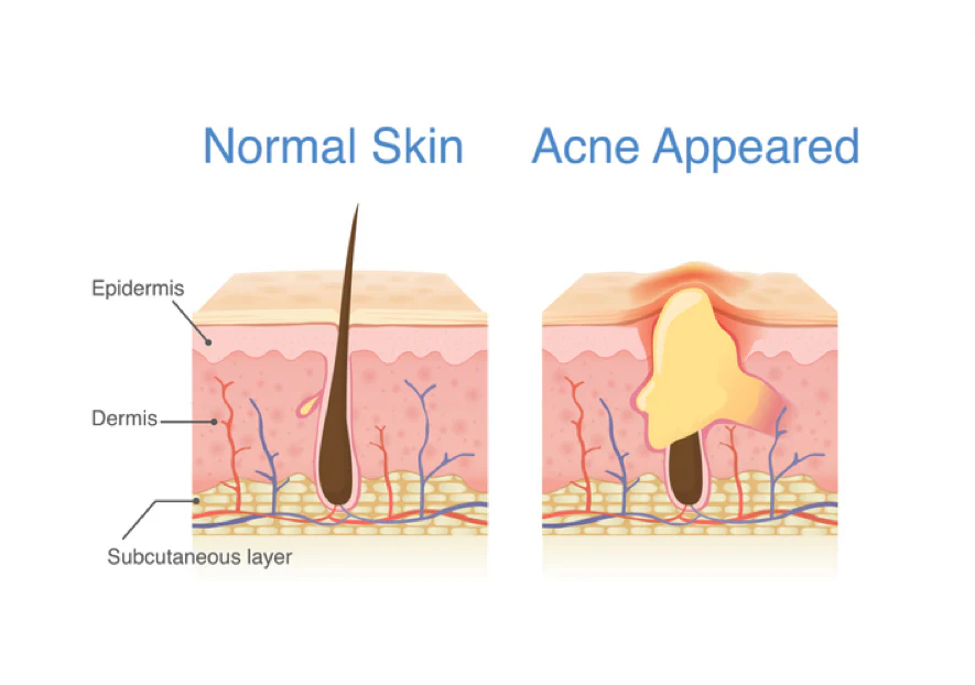Acne & Scars Management acne skin diagram